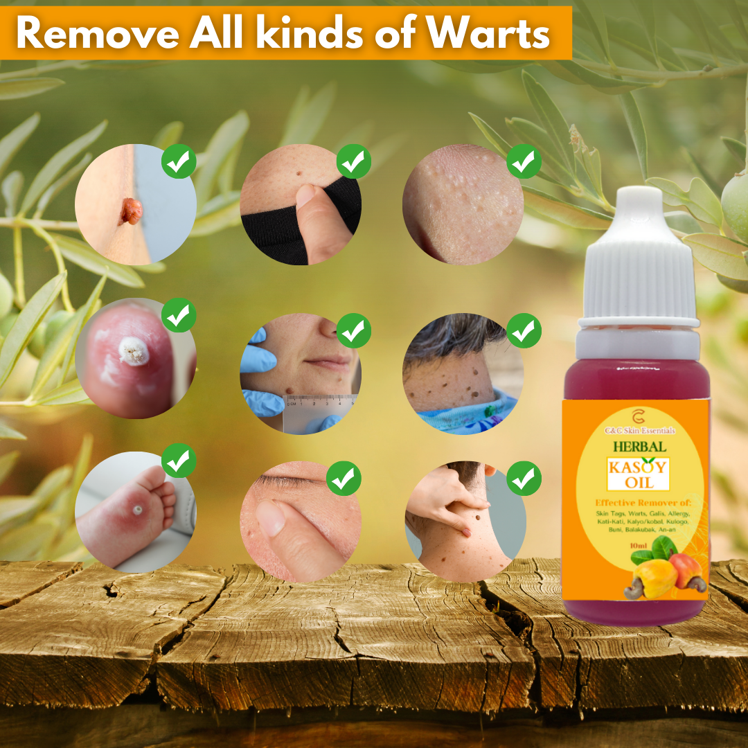 Kasoy Oil Effective Warts and Mole Remover 10ml