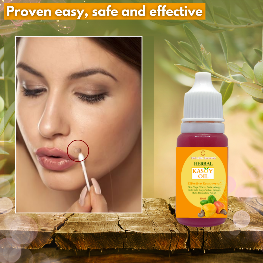 Kasoy Oil Effective Warts and Mole Remover 10ml