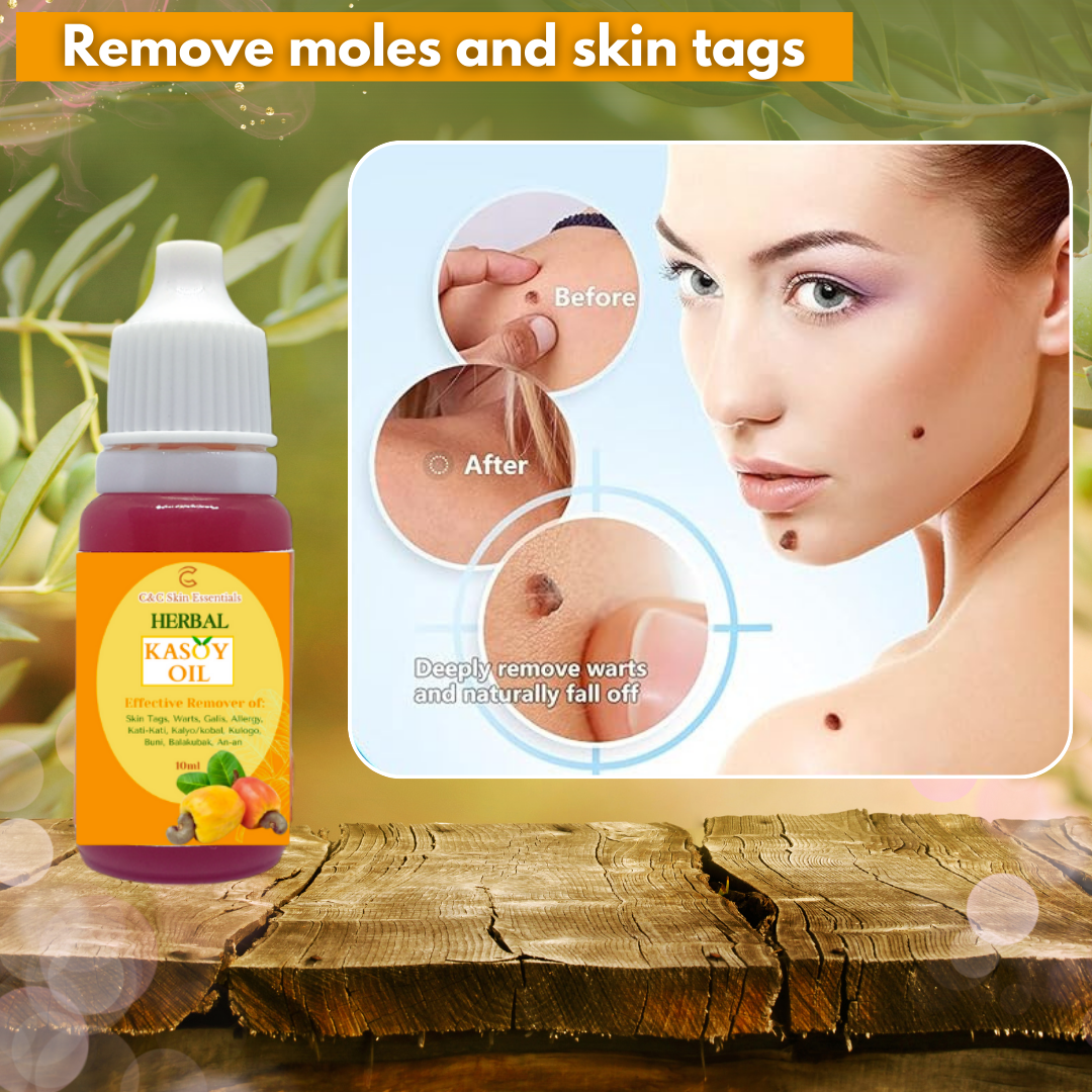 Kasoy Oil Effective Warts and Mole Remover 10ml